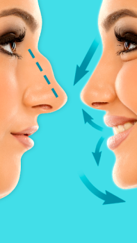Download Rhinoplasty - Nose Editor Beauty for Android screenshot 4